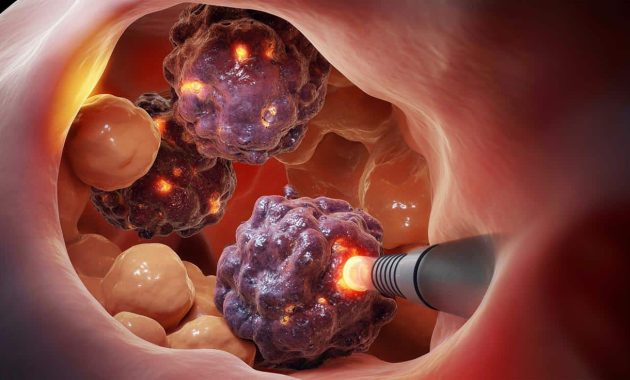 A revolutionary therapy could eliminate 92% of cancer cells while preserving healthy tissue